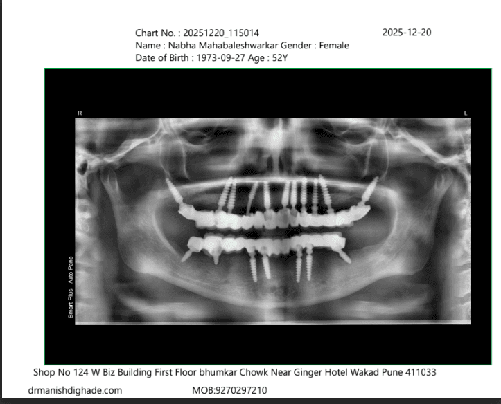 Nabha Mahabaleshwarkar X-ray after treatment