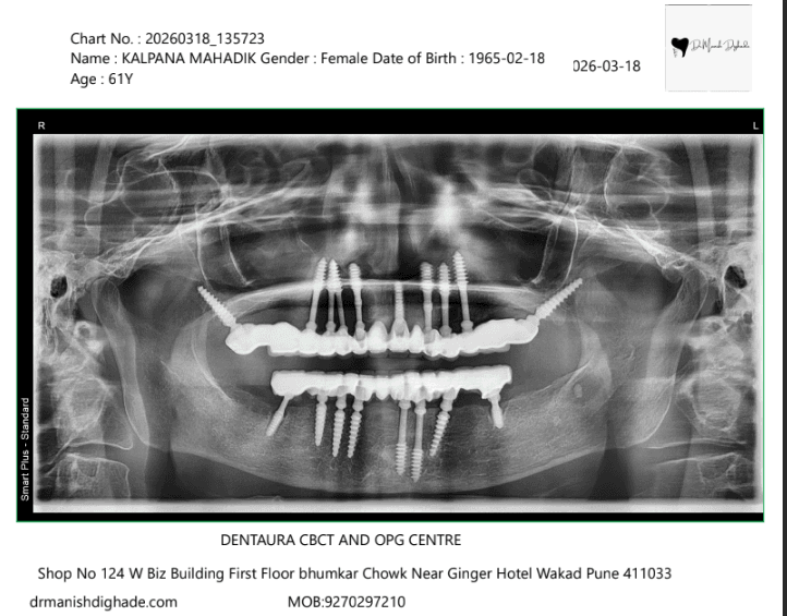 Kalpana Mahadik X-ray before treatment